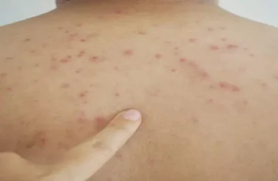 Small Pox