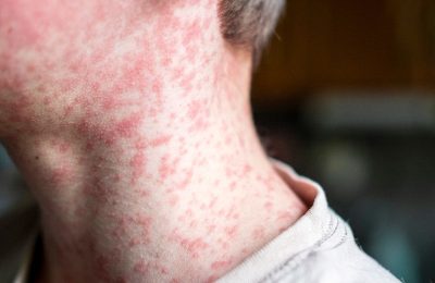 boy-with-measles-1296-728-header