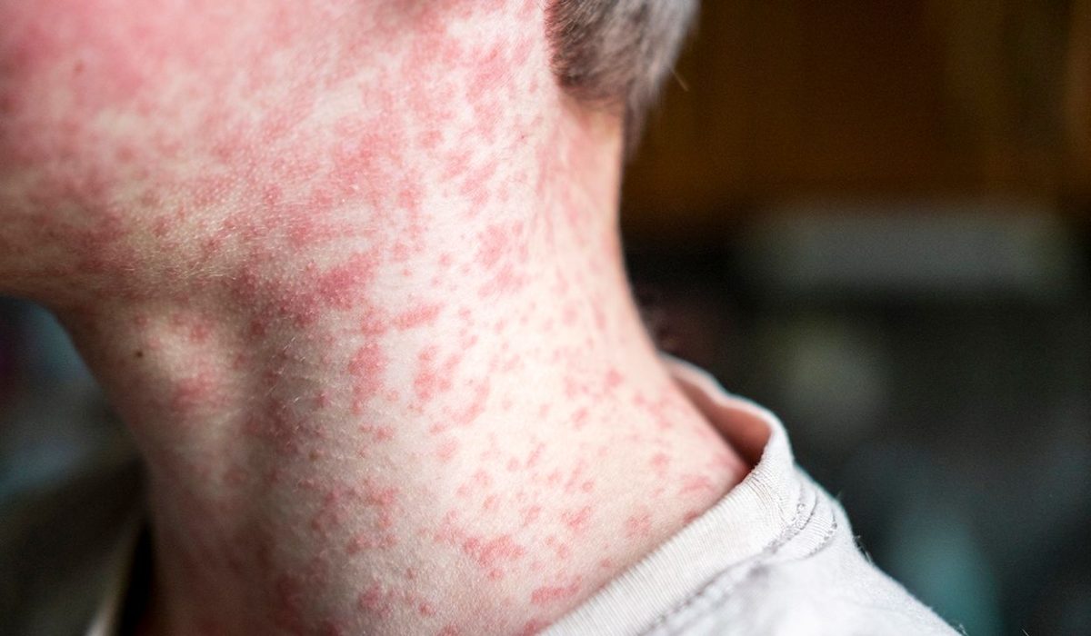 boy-with-measles-1296-728-header